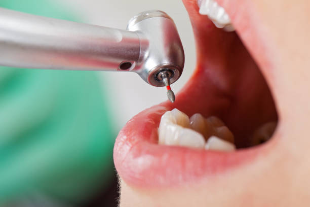 Best Dentist for Tooth Abscess  in New Miami, OH